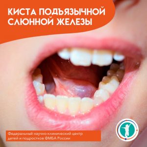 Киста подъязычной слюнной железы.