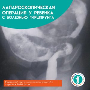 Лапароскопическая операция у ребенка с болезнью Гиршпрунга