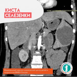 Оперирована девочка 16 лет с диагнозом киста селезенки.