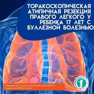 Торакоскопическая атипичная резекция правого легкого у ребенка 17 лет с буллезной болезнью