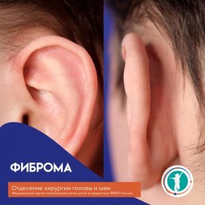 Удаление новообразования с пластикой дефекта местными тканями под эндотрахеальным наркозом
