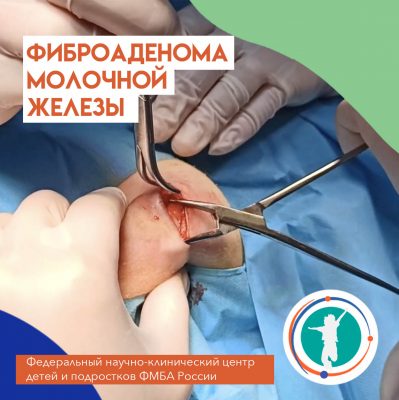 Фиброаденома молочной железы