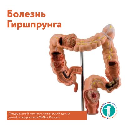 Болезнь Гиршпрунга